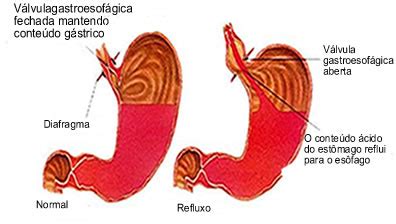 Refluxo gastroesofágico Causas e sintomas do refluxo Mundo Educação