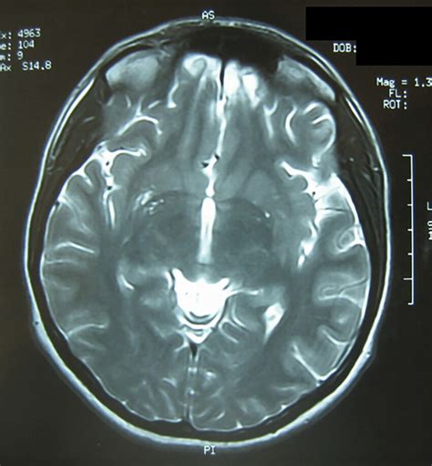 MRI of a 27-year-old female patient with anosmia after a car accident... | Download Scientific ...