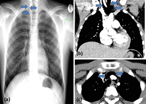 Spontaneous pneumomediastinum | BMJ Case Reports