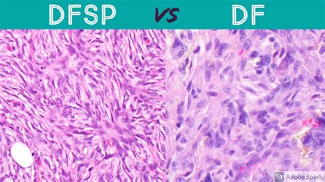 Dermatofibrosarcoma Protuberans Histology