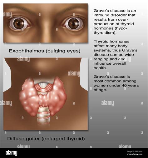 Graves Disease Illustration Stock Photo Alamy