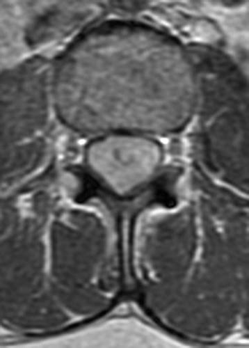 Myxopapillary Ependymoma | Radsource