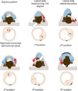 Horizontal Canal BPPV | Vestibular First