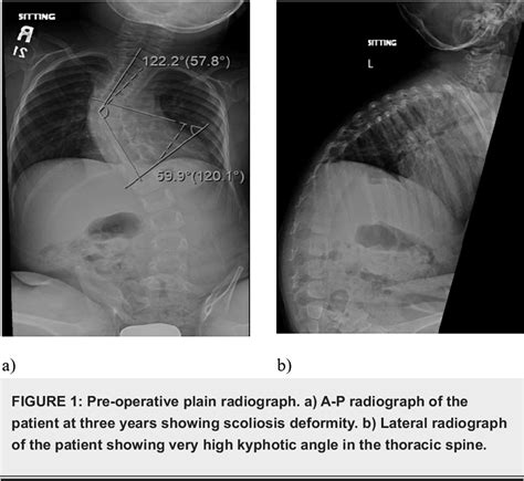 Figure From Outcome Of Vertical Expandable Prosthetic Titanium Rib