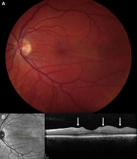 Inner Outer And Full Thickness Retinal Folds After Rhegmatogenous