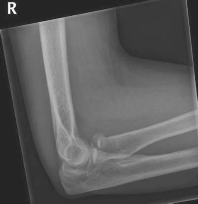 Lateral Radiograph Of A Right Elbow With A Mason Type Ii Fracture