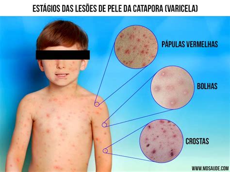 Catapora Varicela Sintomas Transmiss O E Tratamento Md Sa De