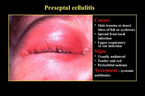 diffuse eyelid diseases