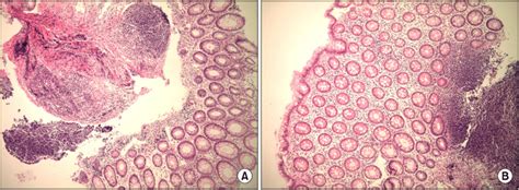 Pathologic findings of the cecum. Inflammation with infiltration of ...