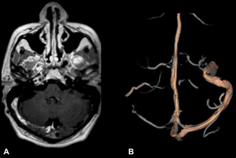 A Mr With Gadolinium Right Transverse And Sigmoid Sinuses With Partial