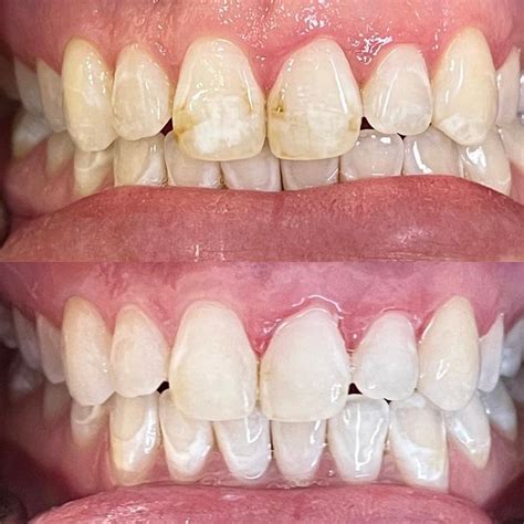 Icon Resin Infiltration Orange County Pediatric Dentistry