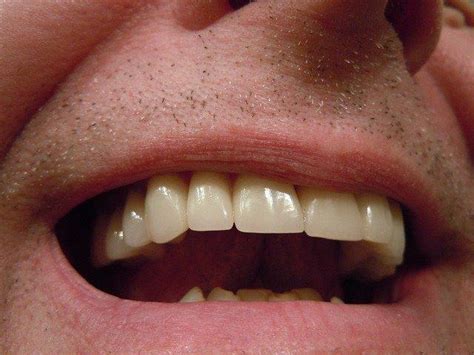 Cómo remediar el bruxismo causas y soluciones Clínica Dental Edo