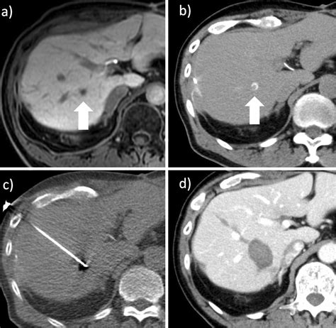 Radiofrequency Ablation Combined With Hepatic Artery Embolization Using