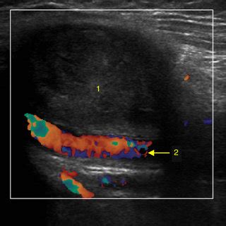 Doppler ultrasound of the right superficial femoral artery pseudoaneurysm. | Download Scientific ...