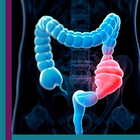 Constipação Intestinal Cighep