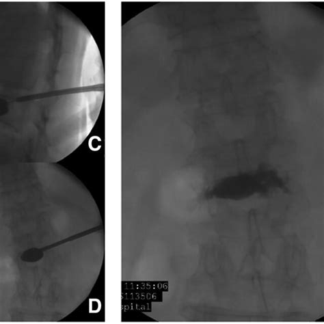 Percutaneous Kyphoplasty Using A Single Balloon Device Preformed In L2 Download Scientific