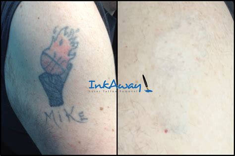 Tattoo Removal Results in Chadds Ford, PA | InkAway