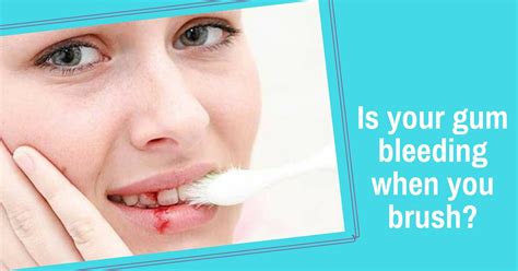 Reasons For Bleeding Gums Dr Sravanthi Expert Dental Care