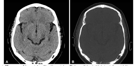 Figure 1 from Arachnoid Granulations Mimicking Multiple Osteolytic Bone Lesions in the Occipital ...