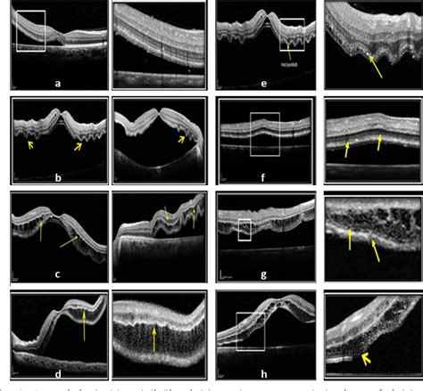 Figure 4 From Analyse De La Macula Par OCT Spectral Domain Dans La