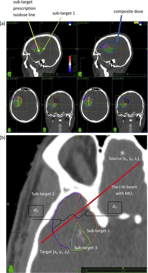 Multi Staged Robotic Stereotactic Radiosurgery For Large Cerebral Arteriovenous Malformations