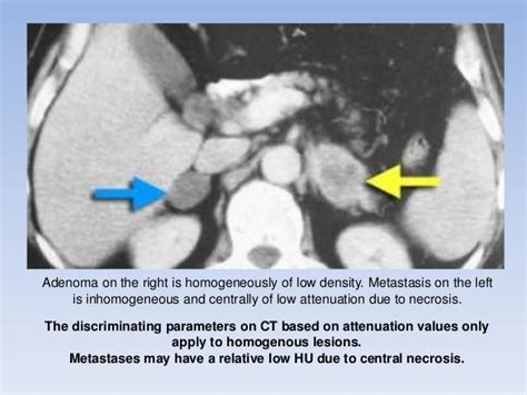 Adrenal Gland Tumors Radiology