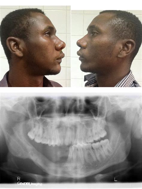 Profile Photographs Of Same Patient Shown In Fig 7 Showing Symmetry