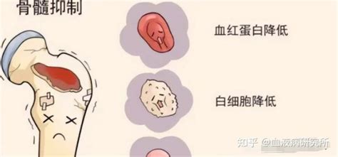 化疗导致骨髓抑制——血液病、肿瘤康复路上的“拦路虎” 知乎