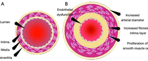 The Cross Sectional View Of The Blood Vessels Of The A Young And B