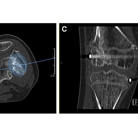 Four months postoperative x-ray showing a valgus (20°) of the left... | Download Scientific Diagram