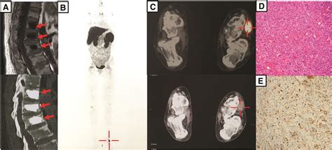 Tumor Induced Osteomalacia Combined With Increased Bone Reso Medicine