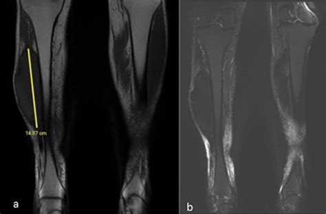 Calcific Myonecrosis Diagnostic Dilemma The Annals Of The Royal