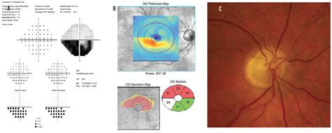 NAION: What to Do and When - Glaucoma Today