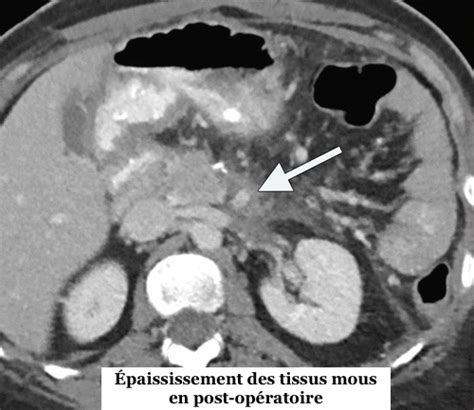 Un recueil des signes radiologiques de complications post opératoires