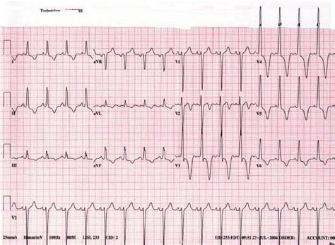 Left Ventricular Hypertrophy On Ecg