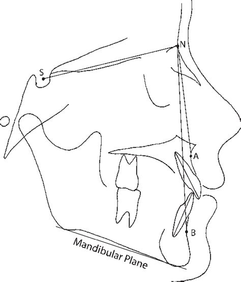 Figure 1 From Relationship Between Dental Arch Width And Vertical