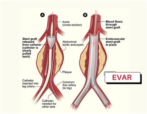 Aortic Stent Graft - My blog