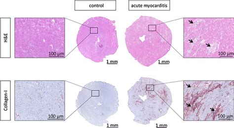 Histopathology In Acute Myocarditis This Figure Shows An Example For