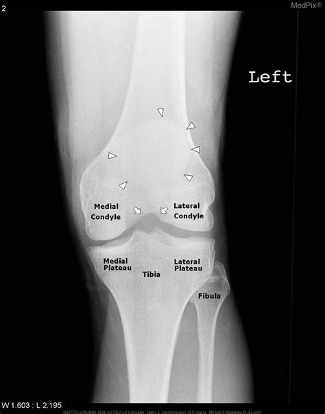 Tibial Plateau Fracture Xray