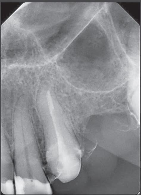 Preoperative Radiographic Assessment Showing Tooth With Permanent