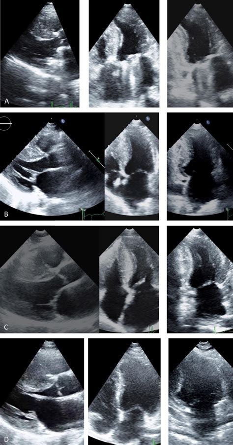 Transthoracic Echocardiogram Parasternal Long Axis 4 Chamber And