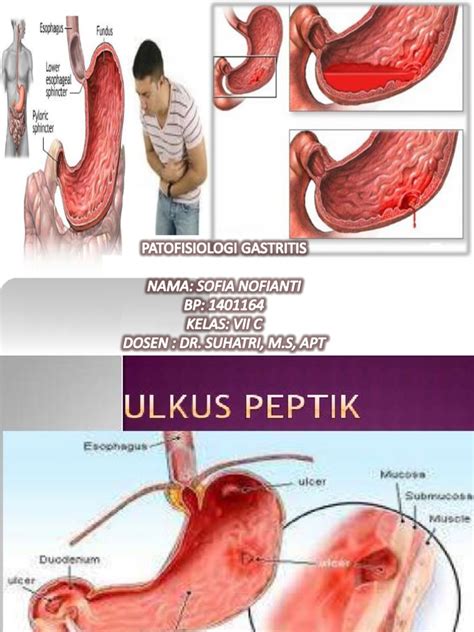 Patofisiologi Maag Pdf