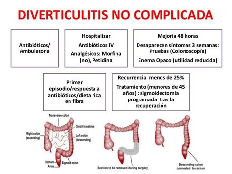 Diverticulitis Diverticulo De Meckel