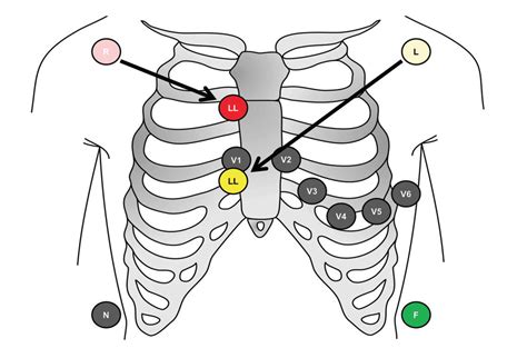 The Lewis Lead | Emergency Medicine Education | Resus