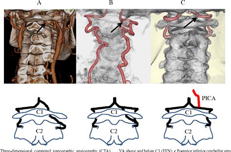 Vertebral Artery Variations And Osseous Anomaly At The C1 2 Level Diagnosed By 3d Ct Angiography