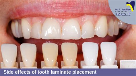 Side Effects Of Dental Veneer Placement Dr Jamilian