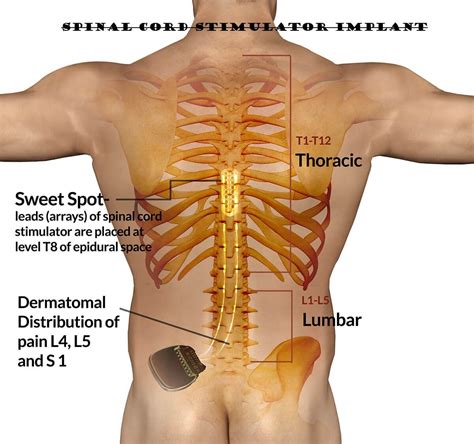 Spinal Cord Stimulator Implant - Health Supplements Information