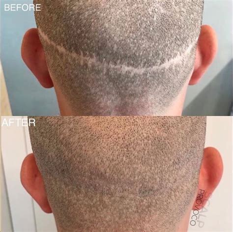 Hair Transplant Before And After Scar