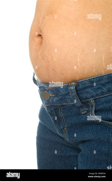 Stretch Mark On Mature Woman Stomach Wearing Blue Jeans Stock Photo Alamy