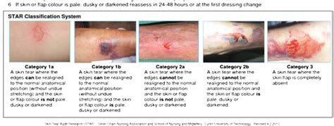 Classification Of Skin Tears